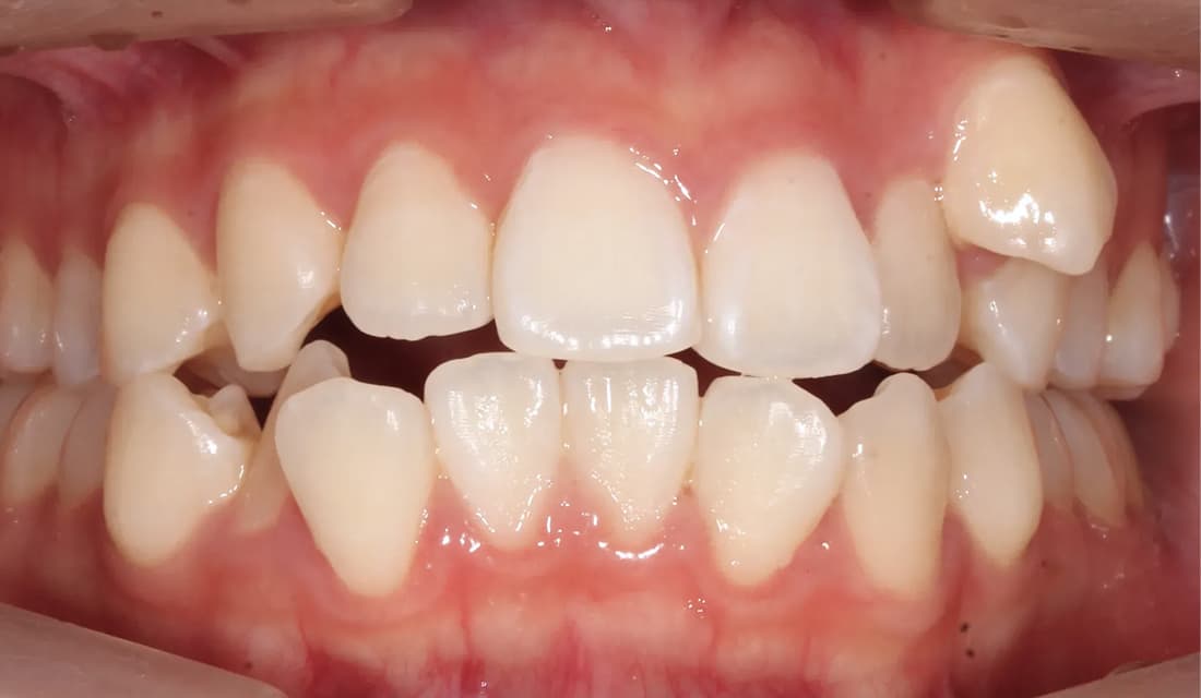 교정 치료 치료 전