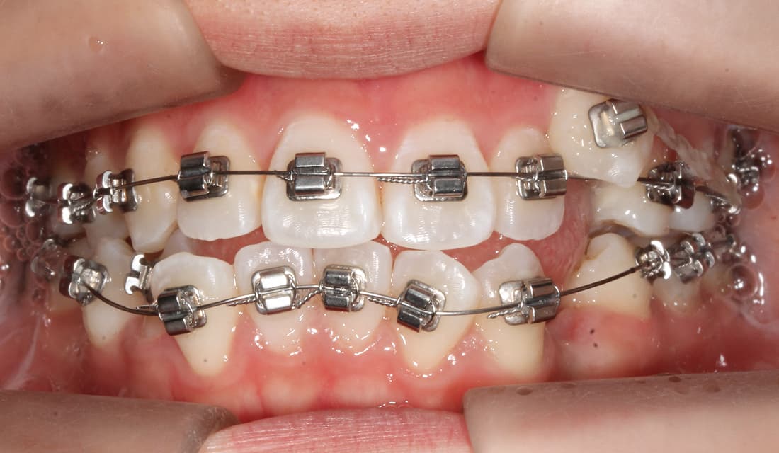 교정 치료 치료중