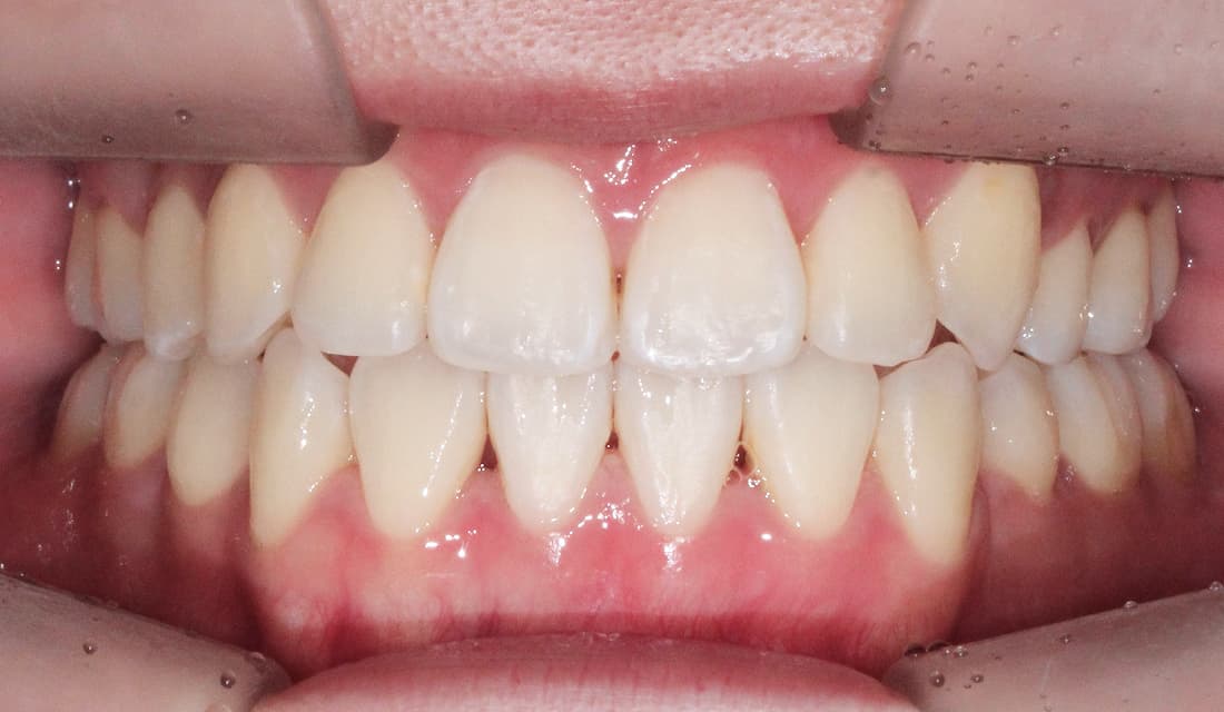 교정 치료 치료 완료