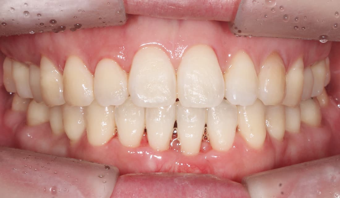 교정 치료 치료 완료