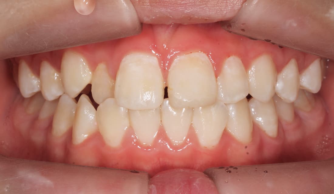 교정 치료 치료 전