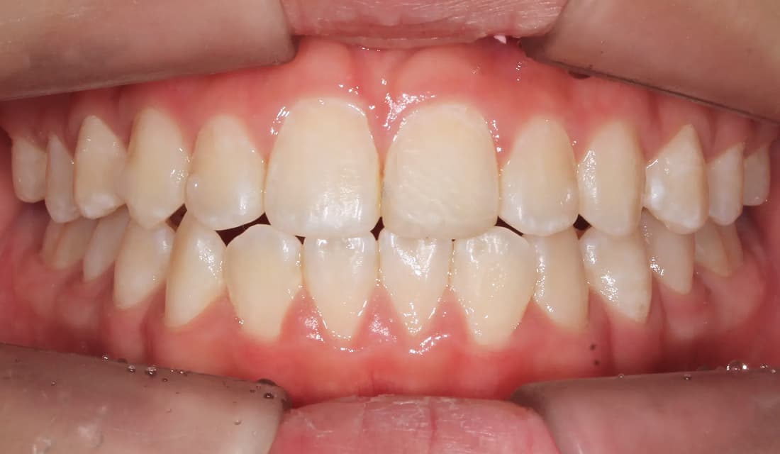 교정 치료 치료 후