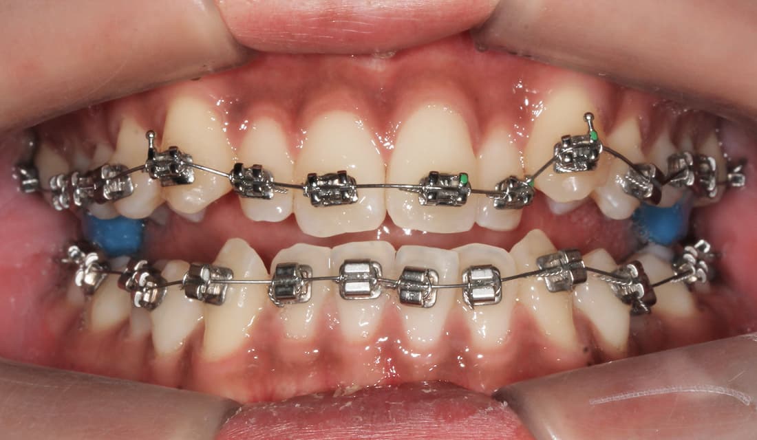 교정 치료 치료중