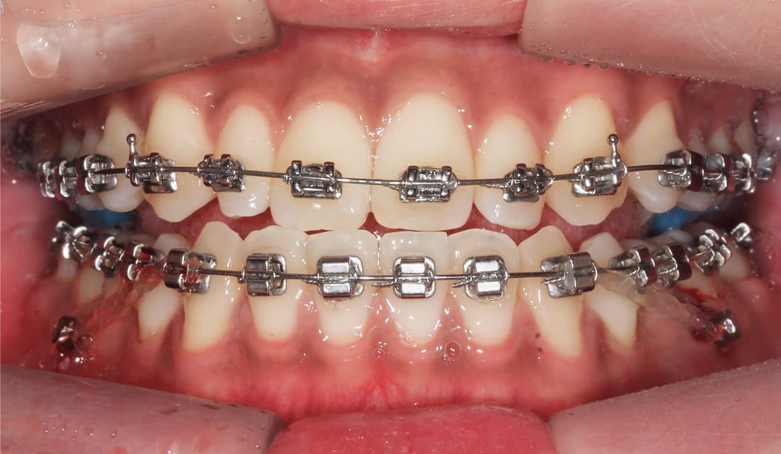 교정 치료 치료중