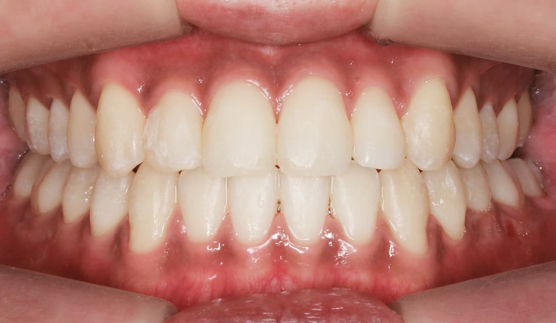 교정 치료 치료 완료