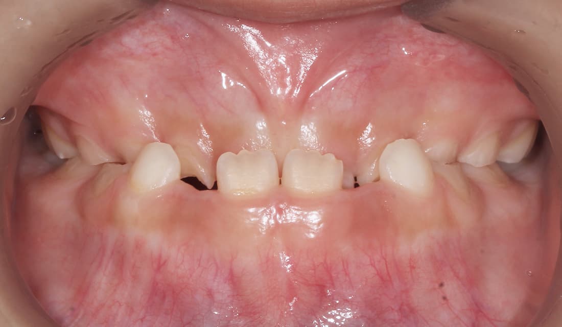 교정 치료 치료 전