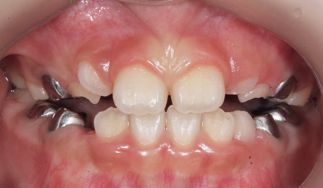 교정 치료 치료 후