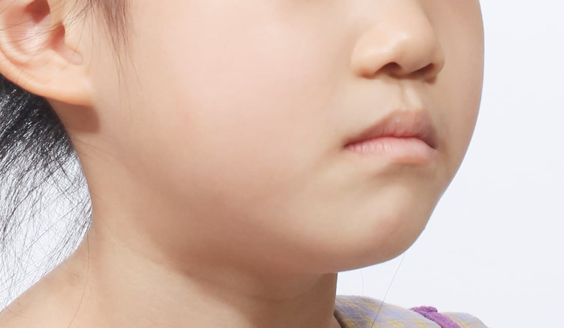 교정 치료 치료 후